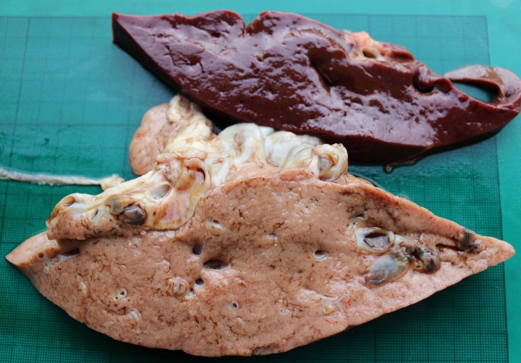 Chronic liver fluke